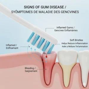 Educational illustration showing minor gum redness and how the right toothbrush for gum disease helps reduce inflammation.